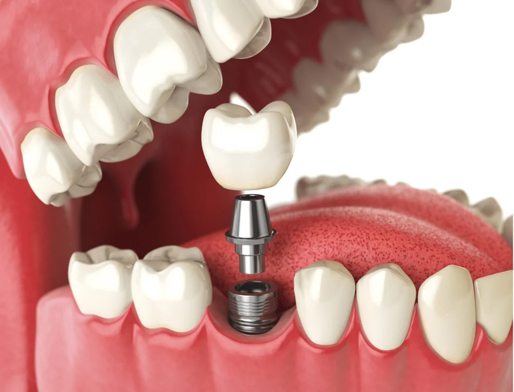 Dental implant components shown beside a missing tooth in a dental treatment illustration
