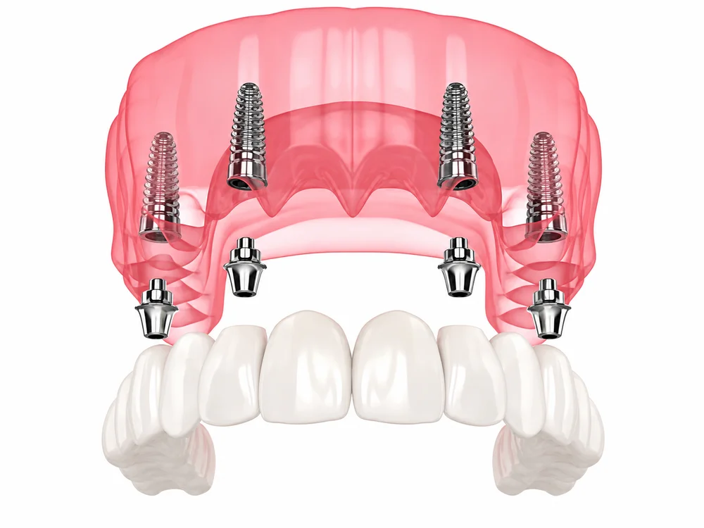 Illustration of multiple dental implants supporting a full-mouth tooth replacement