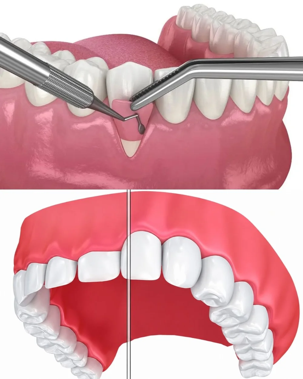 Illustration of gum surgery instruments treating gum recession around a tooth