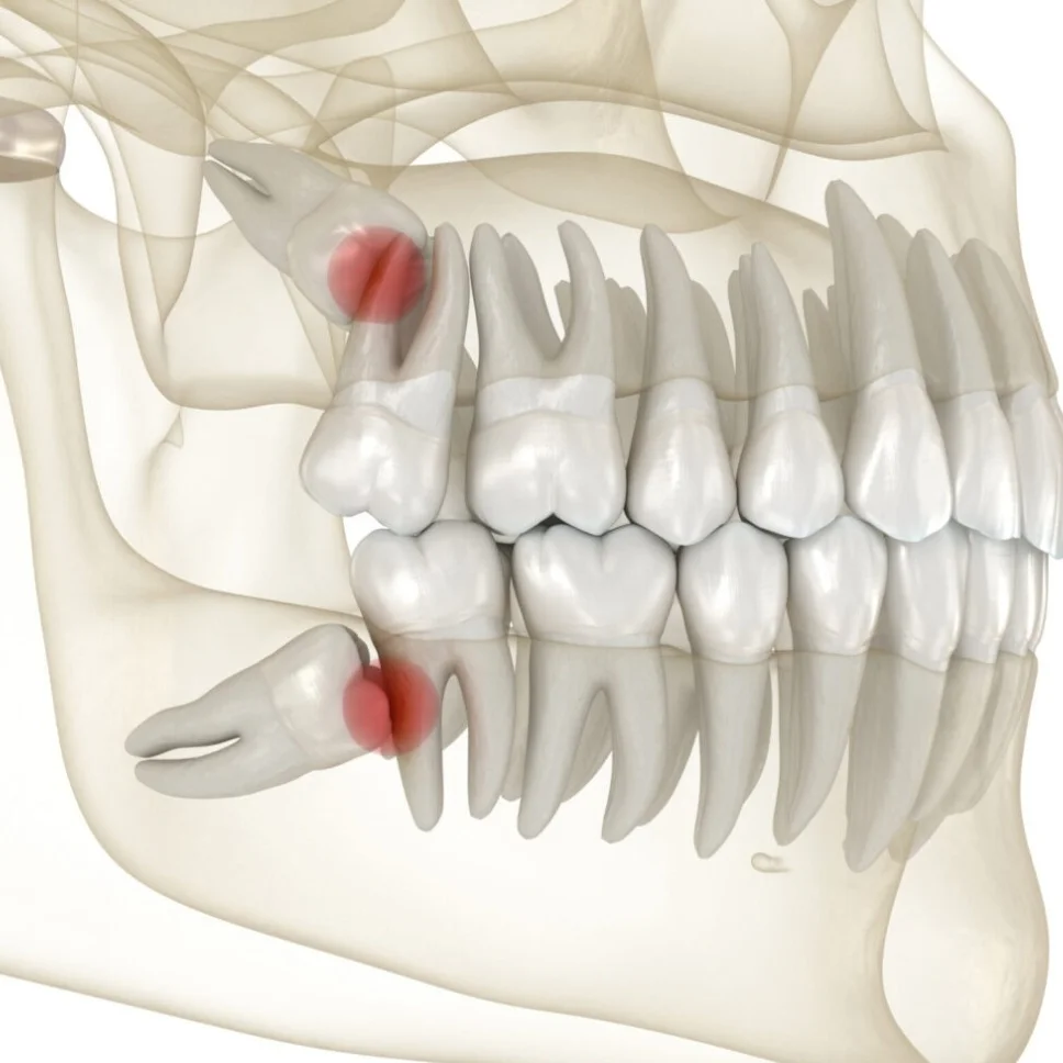 Illustration showing impacted wisdom teeth and areas of discomfort in the jaw